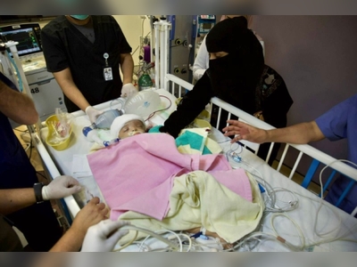 Saudi surgical team announces death of one of the separated Yemeni conjoined twins