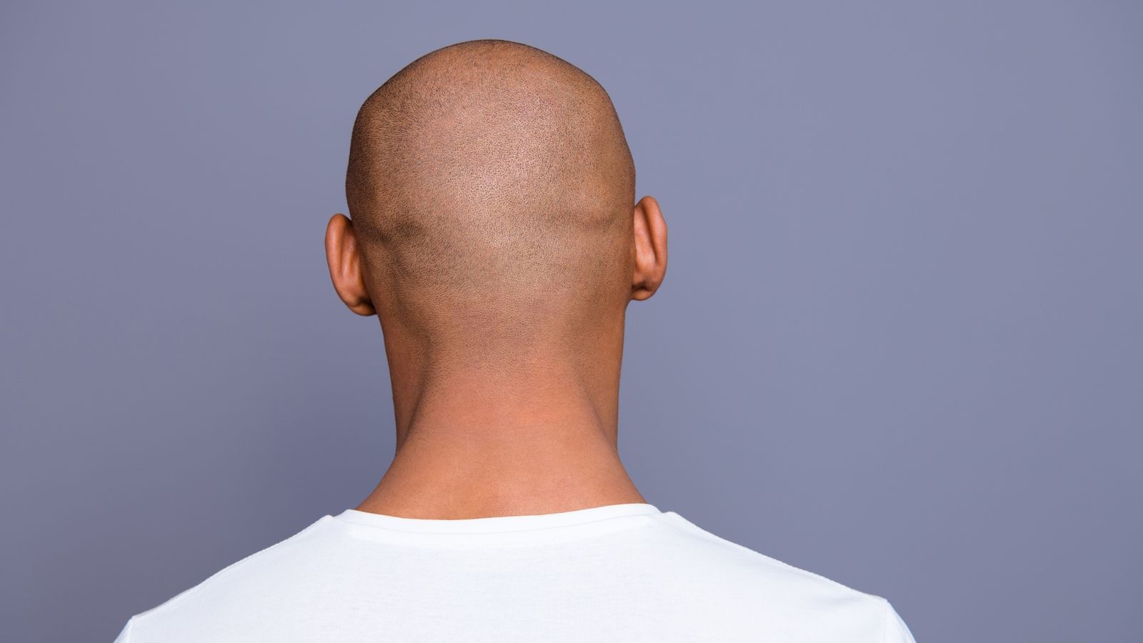 Calling a man bald is sexual harassment, employment tribunal rules