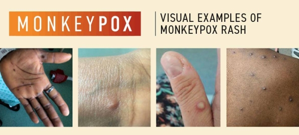 Emergency Committee meets again as Monkeypox cases pass 14,000: WHO